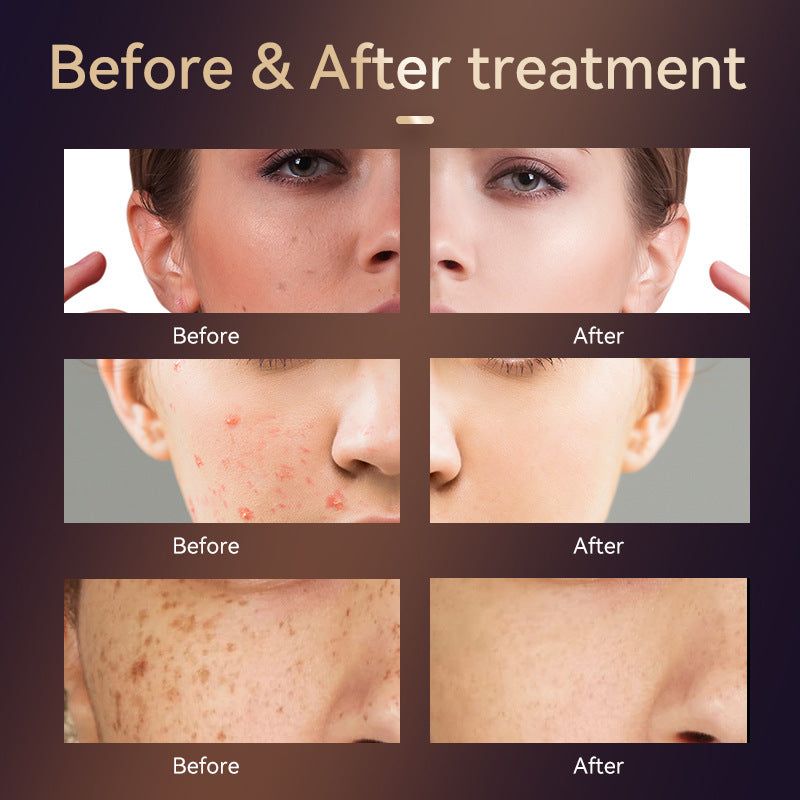 Home Four Band Photon Rejuvenation Device